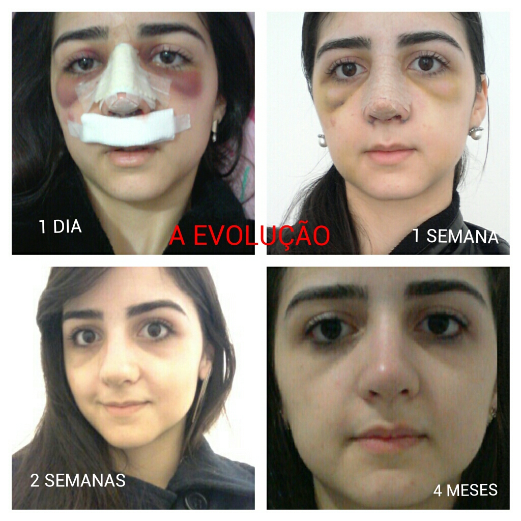 resultado.cirurgia.foto.antes e depois