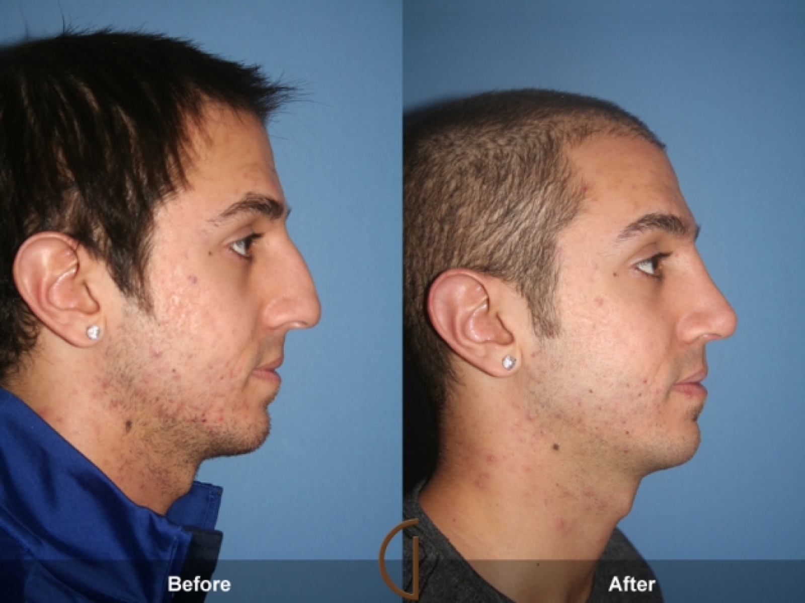 rinoplastia masculina. foto.antes e depois.