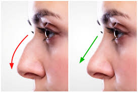 Rinoplastia: o que é, de que forma é realizado o procedimento no nariz.
