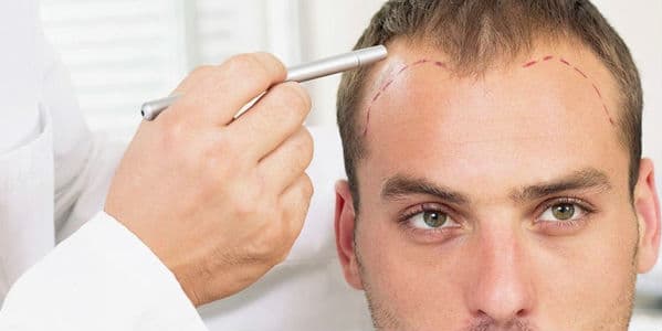 Homem sendo examinado para saber implante capilar masculino preço