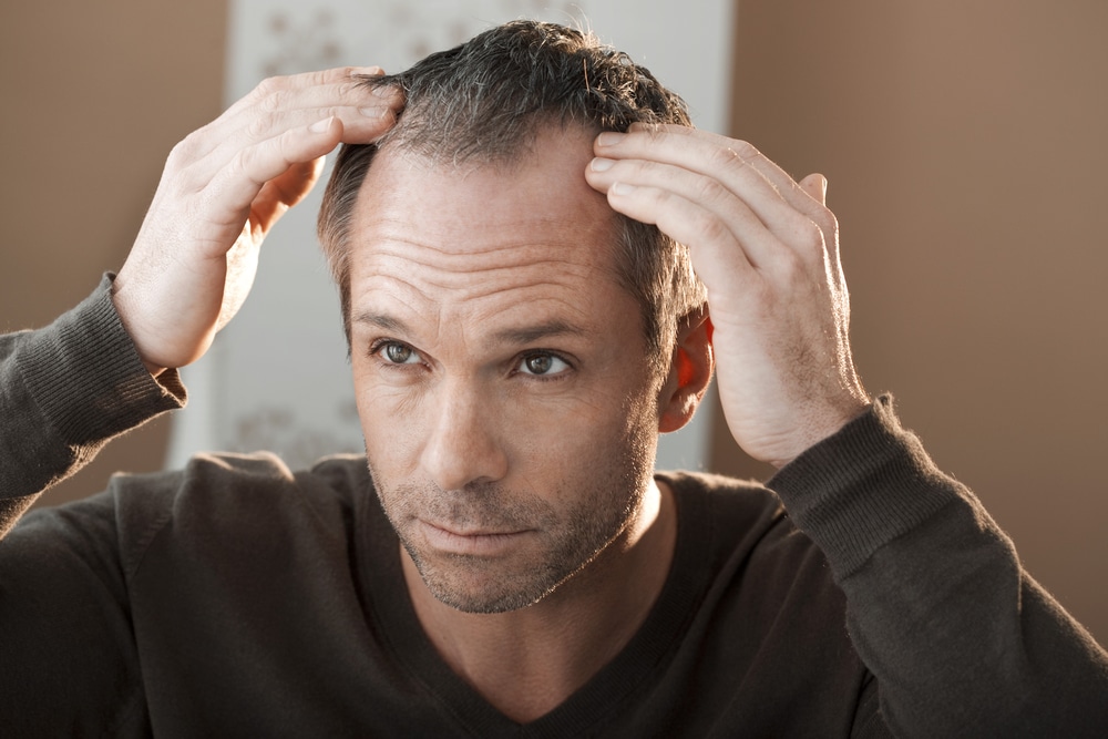 Homem com "buracos" na cabeça e querendo saber mais sobre implante capilar masculino preço